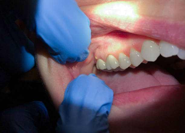 Best Broken or Chipped Tooth Repair in Ramona, CA